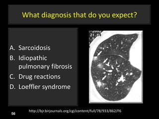 What diagnosis that do you expect?
A. Sarcoidosis
B. Idiopathic
pulmonary fibrosis
C. Drug reactions
D. Loeffler syndrome
56
http://bjr.birjournals.org/cgi/content/full/78/933/862/F6
 