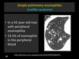 Simple pulmonary eosinophilia
(Loeffler syndrome)
• In a 42-year-old man
with peripheral
eosinophilia
• 53.5% of eosinophils
in the peripheral
blood
58
http://bjr.birjournals.org/cgi/content/full/78/933/862/F6
 
