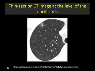Thin-section CT image at the level of the
aortic arch
59 http://radiographics.rsna.org/content/27/2/391/F26.expansion.html
 