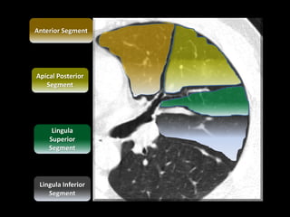 Lingula Inferior
Segment
Lingula
Superior
Segment
Apical Posterior
Segment
Anterior Segment
 