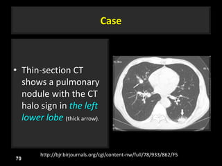 Case
• Thin-section CT
shows a pulmonary
nodule with the CT
halo sign in the left
lower lobe (thick arrow).
70
http://bjr.birjournals.org/cgi/content-nw/full/78/933/862/F5
 
