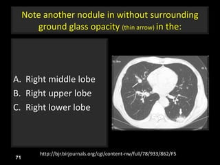Note another nodule in without surrounding
ground glass opacity (thin arrow) in the:
A. Right middle lobe
B. Right upper lobe
C. Right lower lobe
71
http://bjr.birjournals.org/cgi/content-nw/full/78/933/862/F5
 