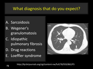 What diagnosis that do you expect?
A. Sarcoidosis
B. Wegener's
granulomatosis
C. Idiopathic
pulmonary fibrosis
D. Drug reactions
E. Loeffler syndrome
73
http://bjr.birjournals.org/cgi/content-nw/full/78/933/862/F5
 