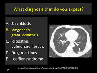 What diagnosis that do you expect?
A. Sarcoidosis
B. Wegener's
granulomatosis
C. Idiopathic
pulmonary fibrosis
D. Drug reactions
E. Loeffler syndrome
74
http://bjr.birjournals.org/cgi/content-nw/full/78/933/862/F5
 