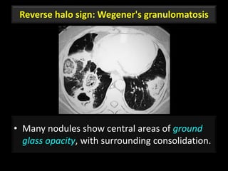 Reverse halo sign: Wegener's granulomatosis
• Many nodules show central areas of ground
glass opacity, with surrounding consolidation.
76
 