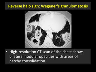 Reverse halo sign: Wegener's granulomatosis
• High-resolution CT scan of the chest shows
bilateral nodular opacities with areas of
patchy consolidation.
77
 
