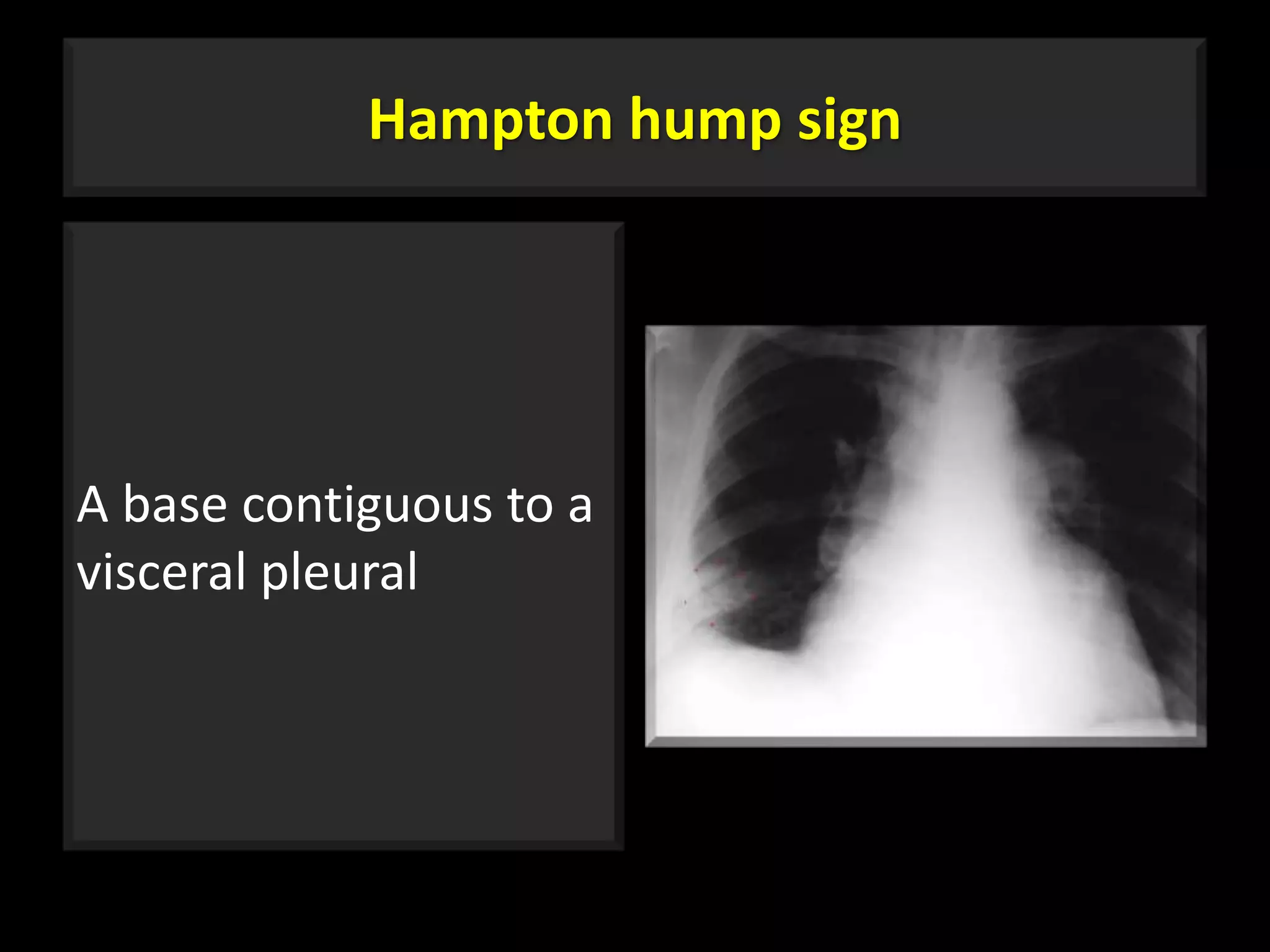 Westerback Sign Hampton Hump Sign