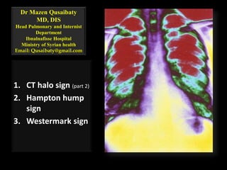 Dr Mazen Qusaibaty
MD, DIS
Head Pulmonary and Internist
Department
Ibnalnafisse Hospital
Ministry of Syrian health
Email: Qusaibaty@gmail.com
1. CT halo sign (part 2)
2. Hampton hump
sign
3. Westermark sign
 