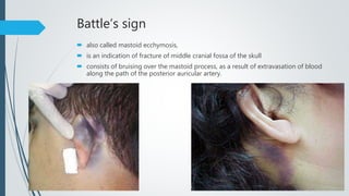 Battle’s sign
 also called mastoid ecchymosis,
 is an indication of fracture of middle cranial fossa of the skull
 consists of bruising over the mastoid process, as a result of extravasation of blood
along the path of the posterior auricular artery.
 