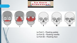 Le Fort I – Floating palate
Le Fort II – Floating maxilla
Le Fort III – Floating face
 