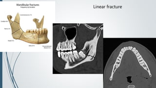 Linear fracture
 