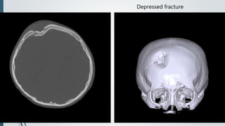 Depressed fracture
 