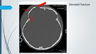 Elevated fracture
 