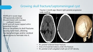 Growing skull fracture/Leptomeningeal cyst
Trauma 1 month ago. Recent right parietal progressive
scalp swelling
Difficult in acute stage
Progressively widening
Lucent lesion with rounded,
scalloped margins
CSF and soft tissue trapped within
expanding fracture.
occur secondary to skull fractures
causing dural tears, allowing
the leptomeninges and/or cerebral
parenchyma to herniate into it.
• Rt. parietal widened linear fracture.
• Area of encephalomalacia under the fracture
• Rt. parietal small subgaleal small cyst of CSF density.
 