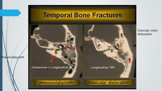 Pneumolabyrinth
Ossicular chain
dislocation
 