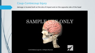 Coup-Contrecoup Injury
damage is located both at the site of impact and on the opposite side of the head
 
