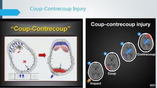 Coup-Contrecoup Injury
 