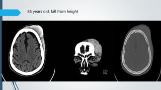 85 years old, fall from height
 