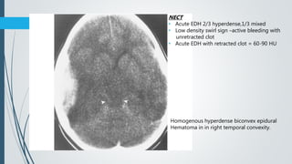 Homogenous hyperdense biconvex epidural
Hematoma in in right temporal convexity.
NECT
• Acute EDH 2/3 hyperdense,1/3 mixed
• Low density swirl sign –active bleeding with
unretracted clot
• Acute EDH with retracted clot = 60-90 HU
 