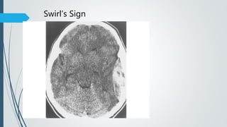Swirl’s Sign
 