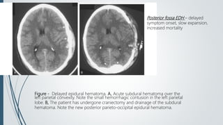 Figure - Delayed epidural hematoma. A, Acute subdural hematoma over the
left parietal convexity. Note the small hemorrhagic contusion in the left parietal
lobe. B, The patient has undergone craniectomy and drainage of the subdural
hematoma. Note the new posterior parieto-occipital epidural hematoma.
Posterior fossa EDH – delayed
symptom onset, slow expansion,
increased mortality
 