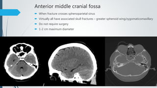 Anterior middle cranial fossa
 When fracture crosses sphenoparietal sinus
 Virtually all have associated skull fractures – greater sphenoid wing/zygomaticomaxillary
 Do not require surgery
 1-2 cm maximum diameter
 