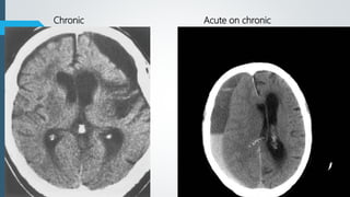Chronic Acute on chronic
 