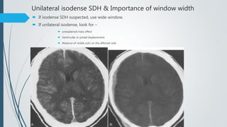 Unilateral isodense SDH & Importance of window width
 If isodense SDH suspected, use wide window.
 If unilateral isodense, look for –
 unexplained mass effect
 Ventricular or pineal displacement
 Absence of visible sulci on the affected side
 