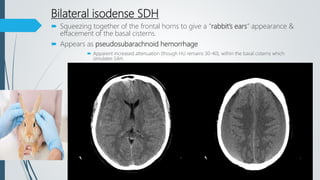 Bilateral isodense SDH
 Squeezing together of the frontal horns to give a “rabbit’s ears” appearance &
effacement of the basal cisterns.
 Appears as pseudosubarachnoid hemorrhage
 Apparent increased attenuation (though HU remains 30-40), within the basal cisterns which
simulates SAH.
 