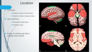 Location
 Common
 Anterior inferior frontal lobes
 Anterior inferior temporal lobes
 Less common
 Parietal/occipital lobes
 Posterior fossa
 Injury at contrecoup site is
usually more severe
 