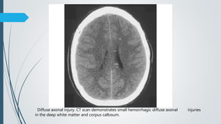 Diffuse axonal injury. CT scan demonstrates small hemorrhagic diffuse axonal injuries
in the deep white matter and corpus callosum.
 