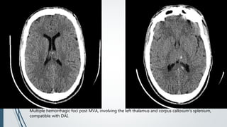 Multiple hemorrhagic foci post MVA, involving the left thalamus and corpus callosum's splenium,
compatible with DAI.
 