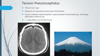 Tension Pneumocephalus
 “Mount Fuji” sign
 Subdural air separates/compresses frontal lobes
 Causes widened interhemispheric space between frontal lobe tips, mimicking
silhouette of Mount Fuji
 +- mass effect ( on frontal horns)
 