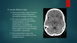 interpretation of ct head for undergraduate and graduate student | PPTX