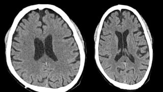 CT HEAD ANATOMY.pptx (NORMAL ANATOMY OF CT HEAD | PPTX