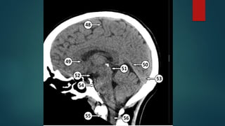 Ct Head Tutorial CT HEAD ANATOMY.pptx (NORMAL ANATOMY OF CT HEAD | PPTX