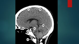 Ct Head Tutorial CT HEAD ANATOMY.pptx (NORMAL ANATOMY OF CT HEAD | PPTX