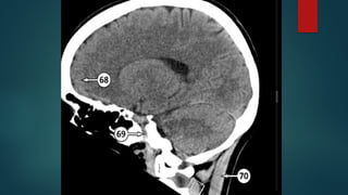 Ct Head Tutorial CT HEAD ANATOMY.pptx (NORMAL ANATOMY OF CT HEAD | PPTX