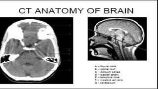 Ct brain presentation | PPTX