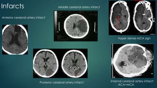 Ct brain presentation | PPTX