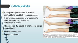 Venous access
• A peripheral percutaneous route is
preferable to establish venous access.
• If percutaneous access is unsuccessful
after two attempts, consider
intraosseous route:
- intraosseous: 18-gauge in infants, 15-gauge in
young children
• femoral venous line
• venous cutdown
 