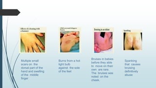 Multiple small
scars on the
dorsal part of the
hand and swelling
of the middle
finger
Burns from a hot
light bulb
against the sole
of the feet
Bruises in babies
before they able
to move on their
own are rare.
The bruises was
noted on the
cheek.
Spanking
that causes
bruising
definitively
abuse
 