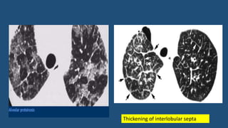 Thickening of interlobular septa
 