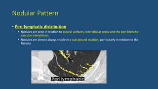 Nodular Pattern
• Peri-lymphatic distribution
• Nodules are seen in relation to pleural surfaces, interlobular septa and the peri-broncho-
vascular interstitium.
• Nodules are almost always visible in a sub-pleural location, particularly in relation to the
fissures
 