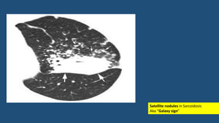Satellite nodules in Sarcoidosis
Aka “Galaxy sign”
 