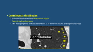 • Centrilobular distribution
• Nodules are limited to the centrilobular region.
• Spare the pleural surfaces.
• The most peripheral nodules are centered 5-10 mm from fissures or the pleural surface
 