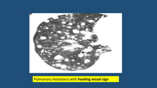 Pulmonary metastasis with Feeding vessel sign
 
