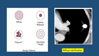 Diffuse calcification
 