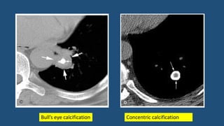 Bull’s eye calcification Concentric calcification
 