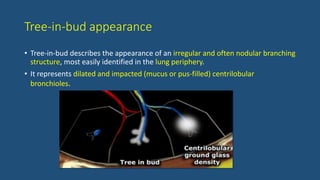 Tree-in-bud appearance
• Tree-in-bud describes the appearance of an irregular and often nodular branching
structure, most easily identified in the lung periphery.
• It represents dilated and impacted (mucus or pus-filled) centrilobular
bronchioles.
 